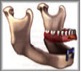 centre-de-sante-dentaire-mont-tremblant-prothese-recouvrement-implant-2